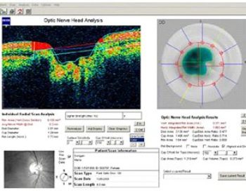 Analiza topografii nerwu wzrokowego